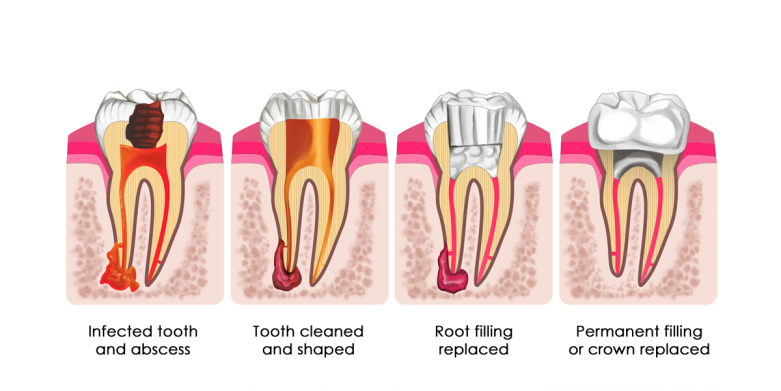 Duns Dental Root Canal