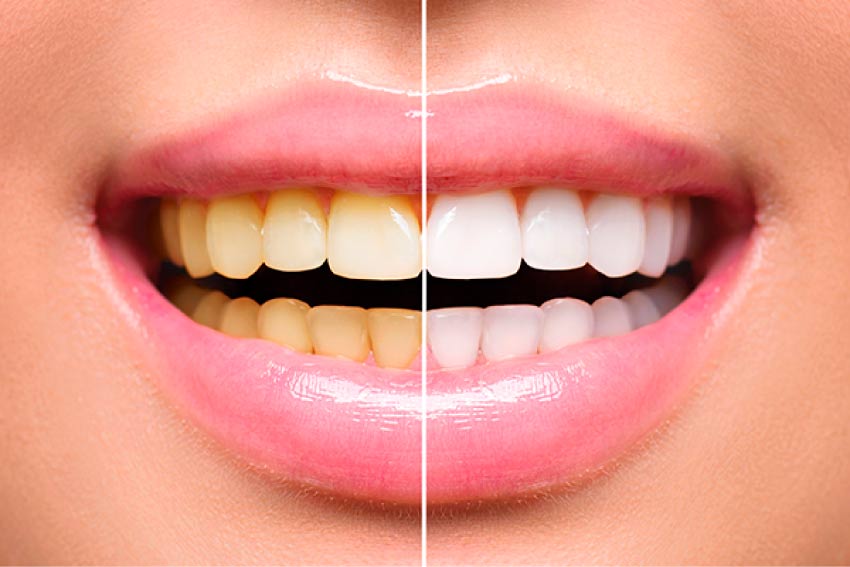Duns Dental Teeth Whitening