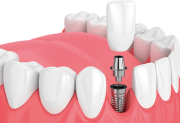duns-dental-dental-implants
